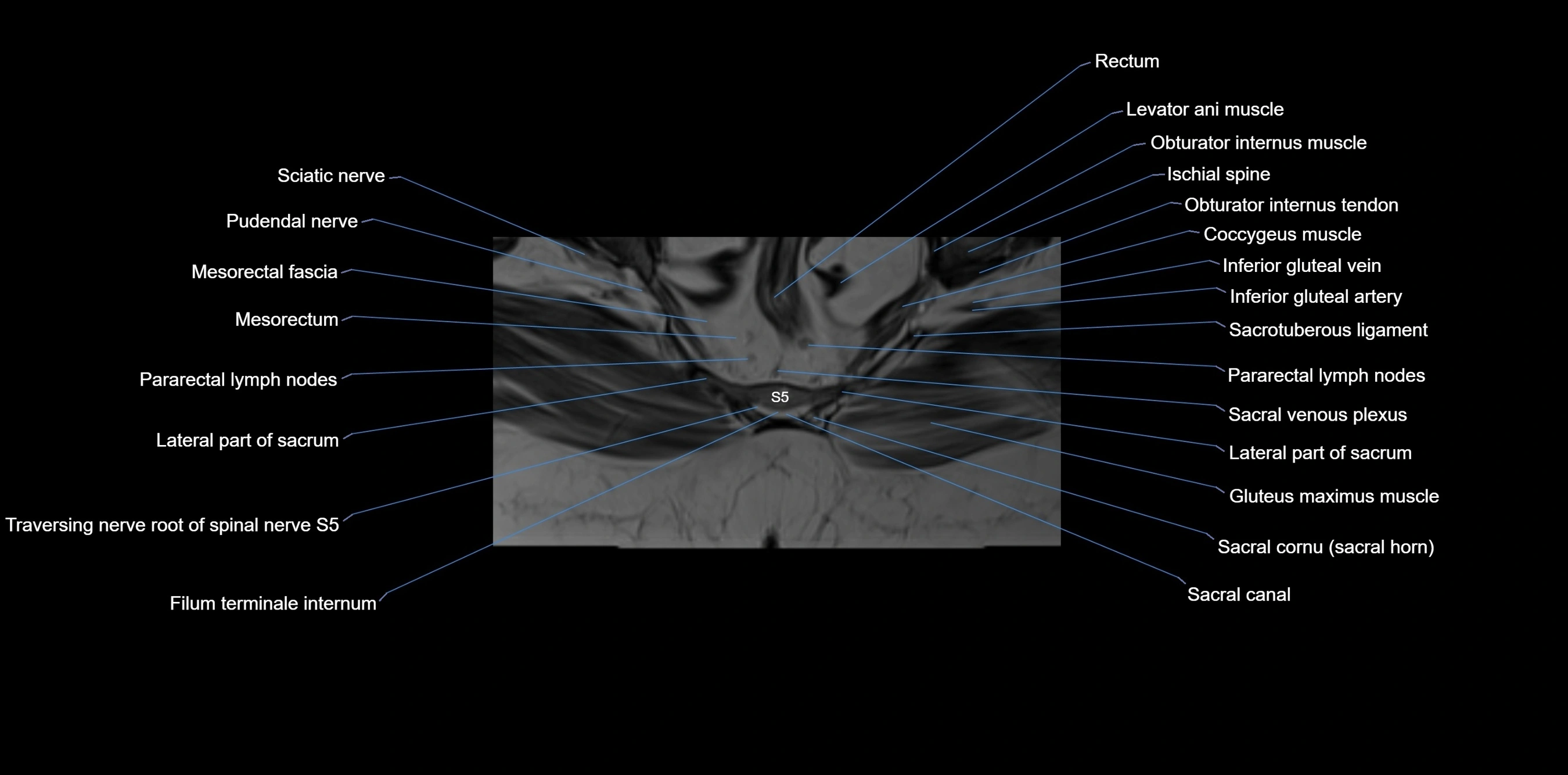MRI sacrum, coccyx and sacroiliac joint axial cross sectional anatomy 3T  radiology  image-img-00001-00059.webp